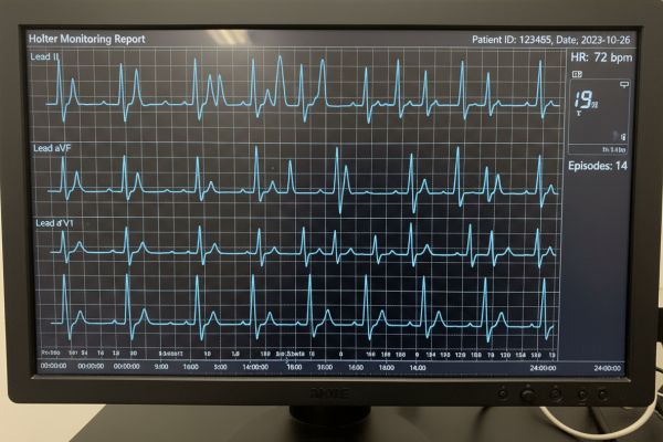 Langzeit-EKG: Ein Umfassender Patienten-Leitfaden